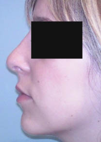 après rhinoplastie