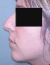 avant rhinoplastie