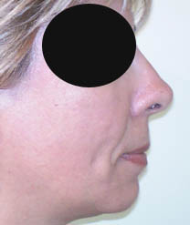 Après rhinoplastie