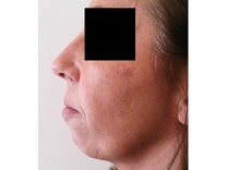 RHINOPLASTIE PROFILOPLASTIE MENTON PREOP